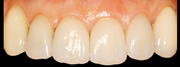Gummy smile: Mikrochirurgische Harmonisierung des Zahnfleisch-verlaufs und Versorgung mit Vollkeramik-Teilkronen nachher